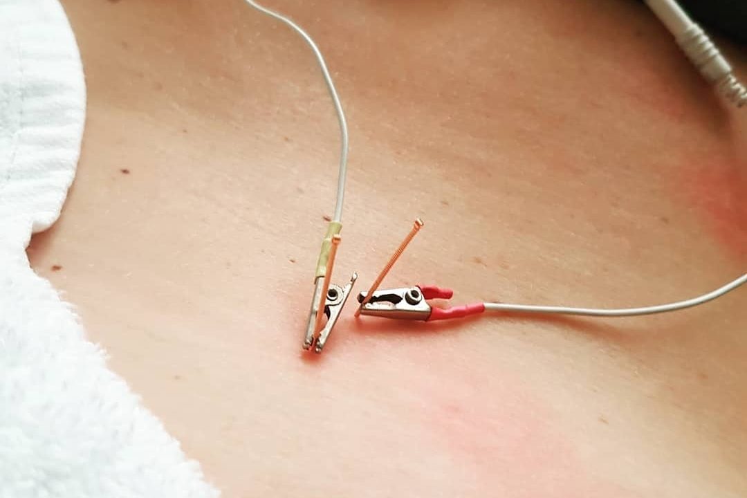 Example of electro-dry needles placed in the back